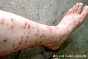 sand flea bites on legs sand-flea-bites-on-legs