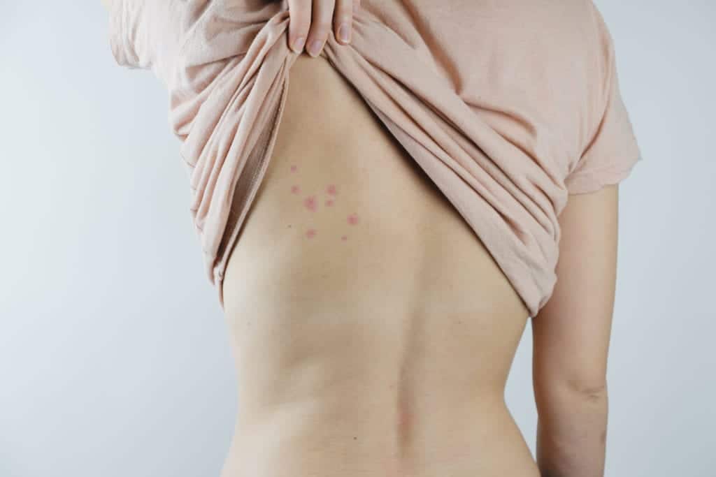 bed bug bites Common Bed Bug Questions Answered