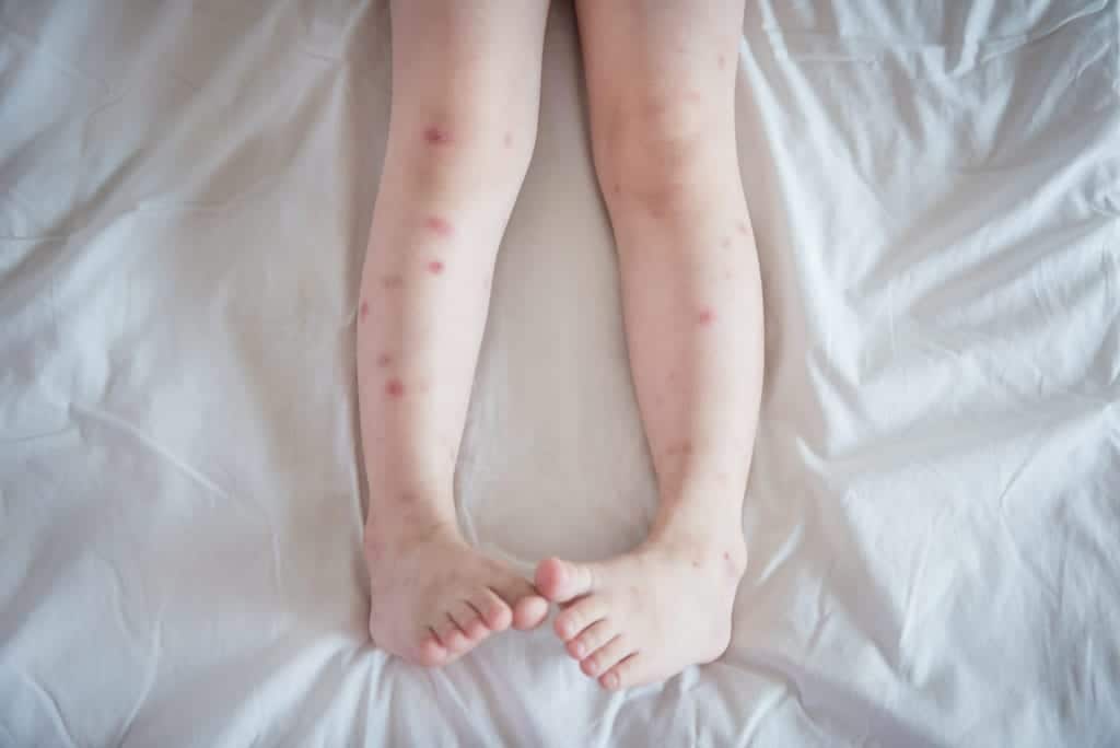 bitten legs New Research Shows Bed Bugs Bites Might Be Deadly