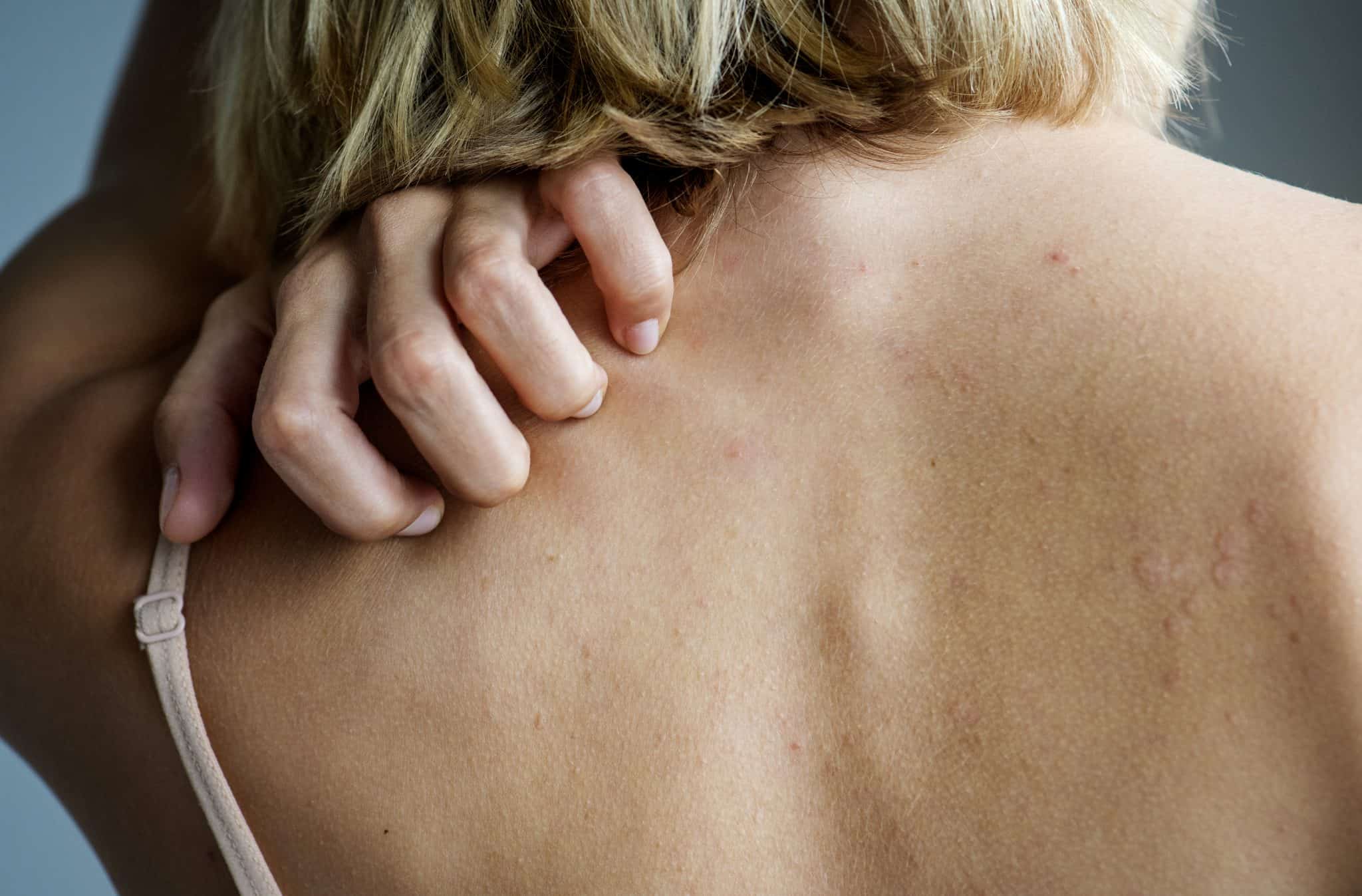 backside of white woman back pain and ache PELHBLZ What To Do For Bed Bug Bites