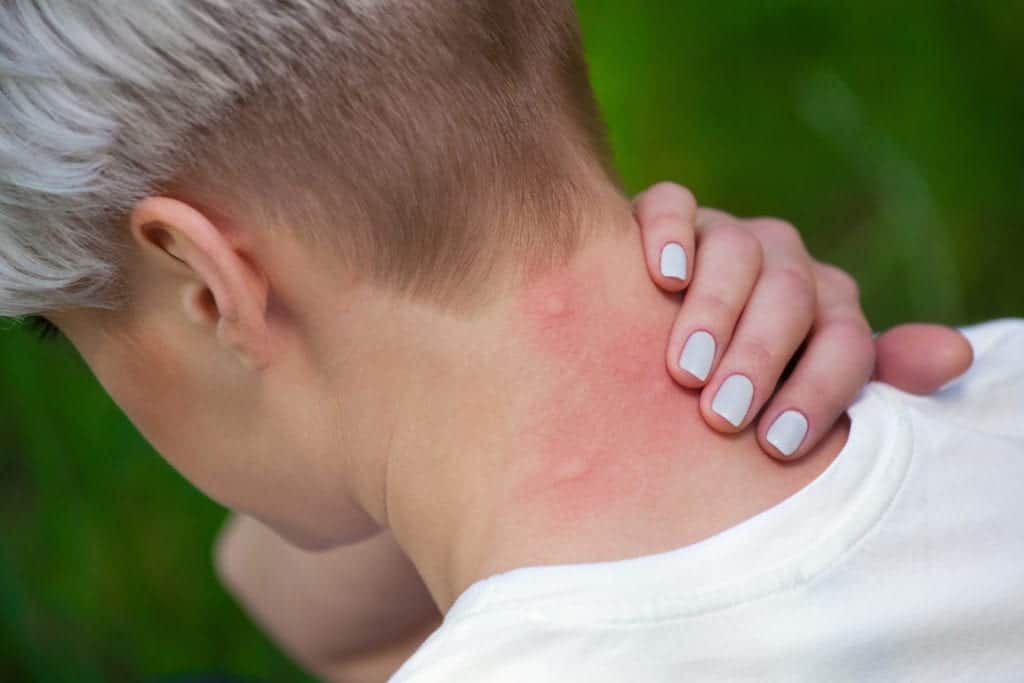 shutterstock 442911190 Why Am I a Mosquito Magnet?