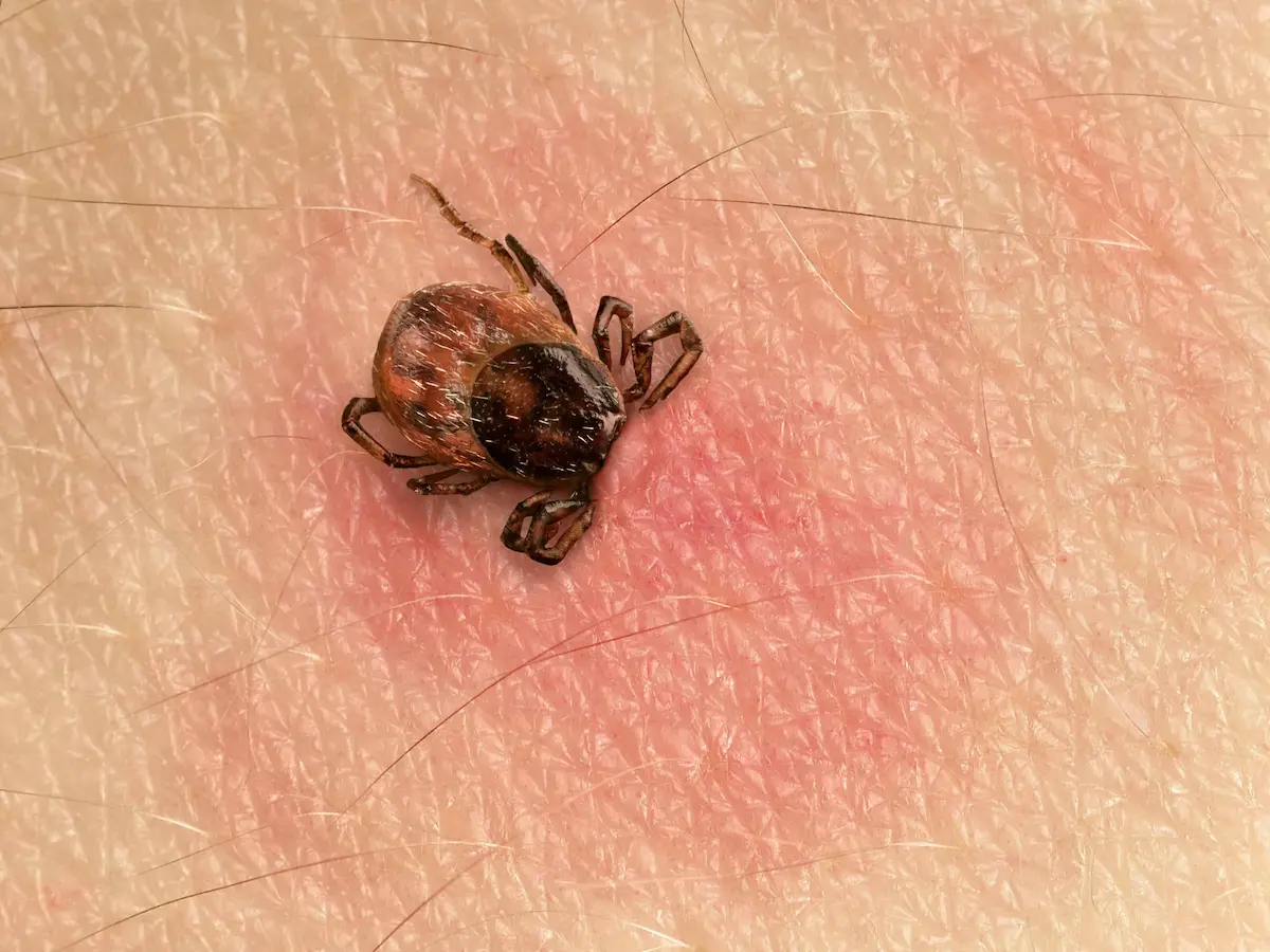 Close-up of a tick attached to irritated human skin