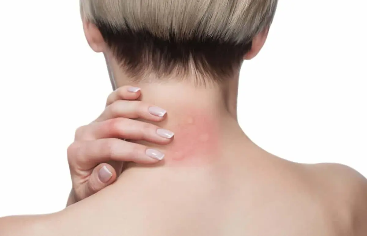 Person scratching mosquito bite rash