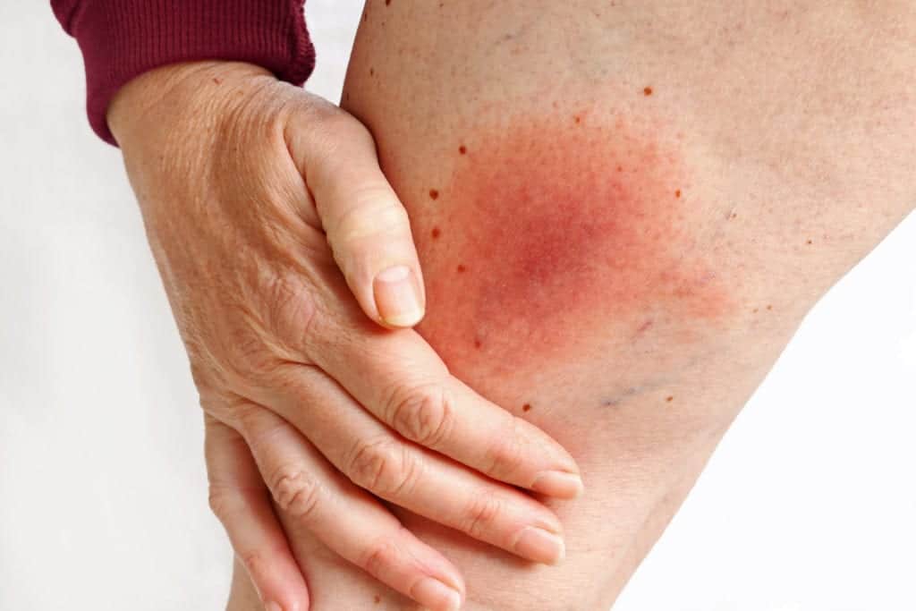 shutterstock 1311500207 1 Health Concerns of Pests - Part 5