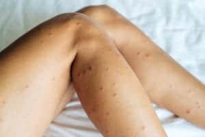shutterstock 1770315002 Female,Legs,With,Many,Red,Spot,And,Scar,From,Sand
