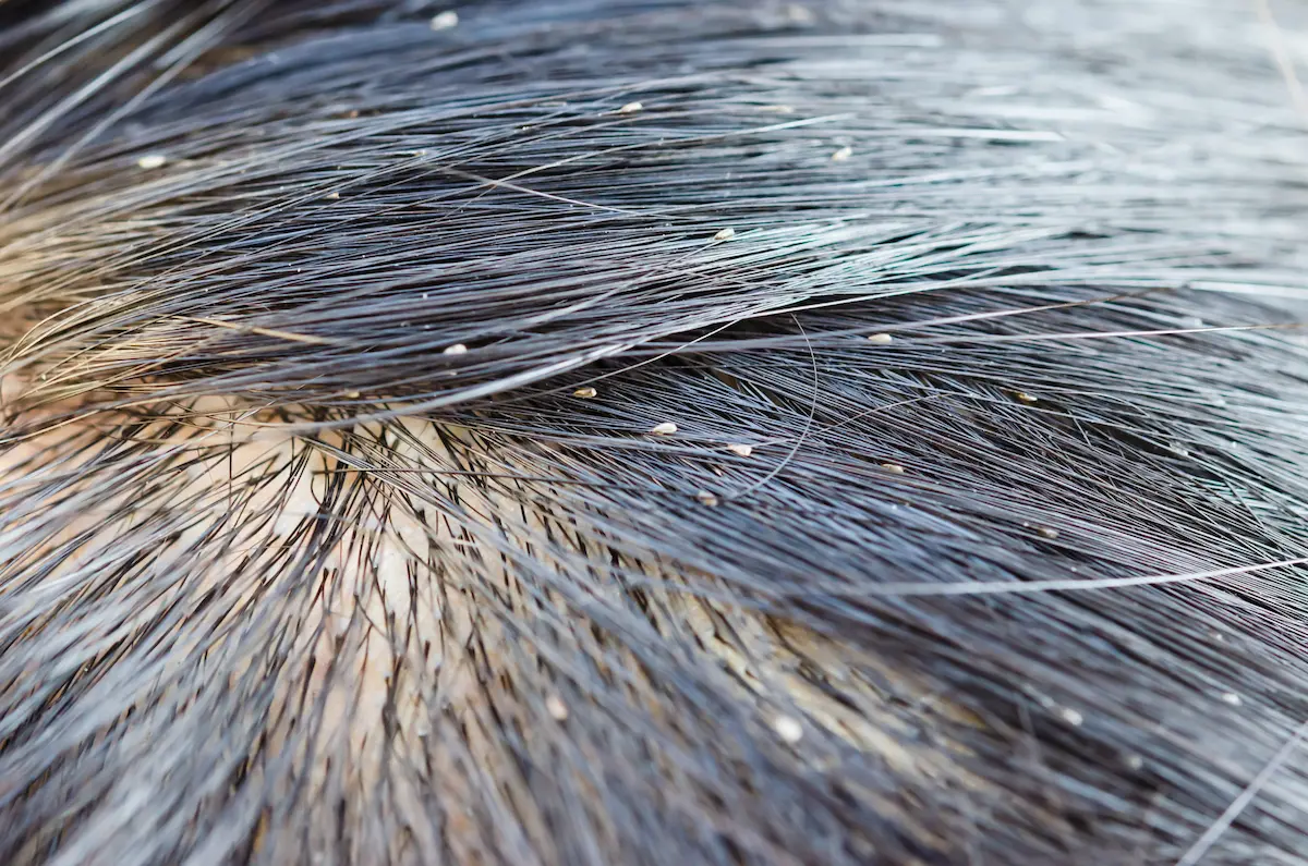 Close-up image of lice eggs attached to human hair strands