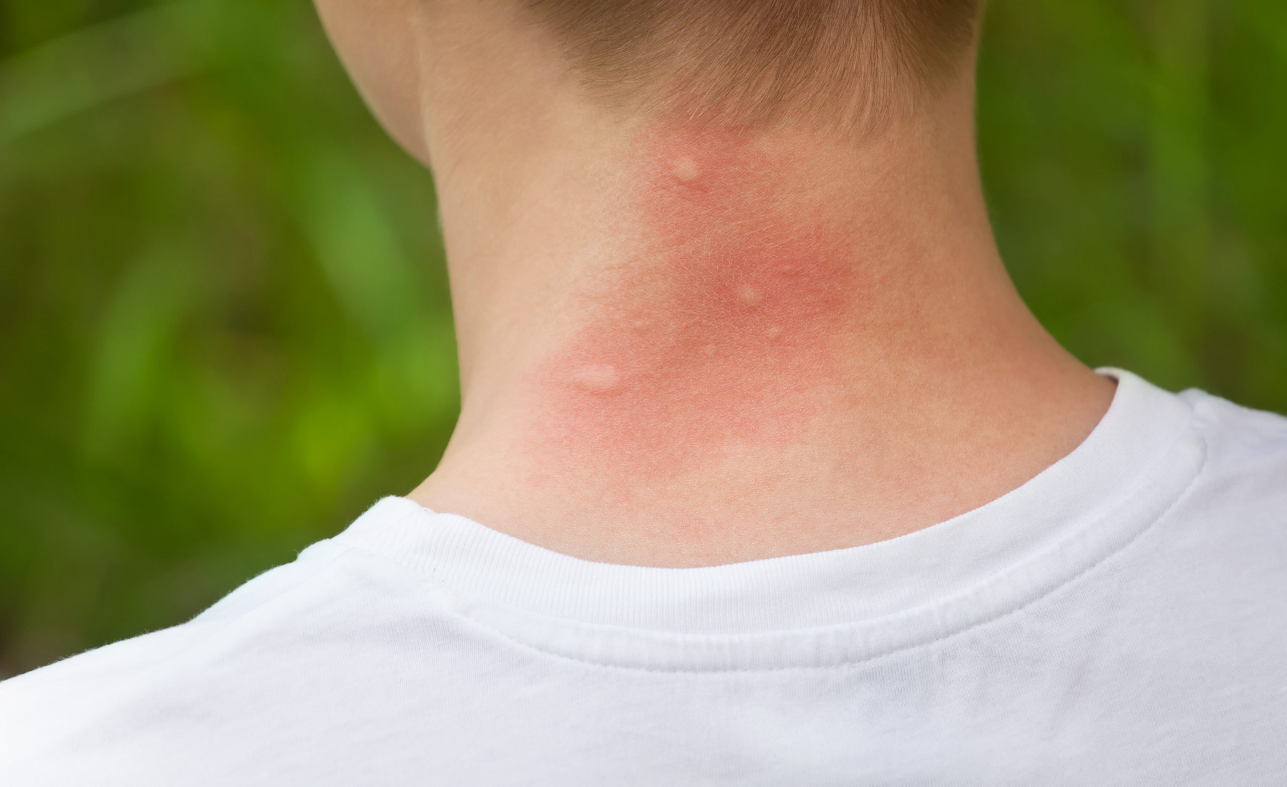 shutterstock 436509421 scaled The Most Mosquito-y Cities