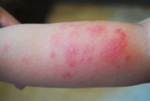 shutterstock 1409573924 Reaction,To,The,Bite,Of,Midges,In,A,Child,Of