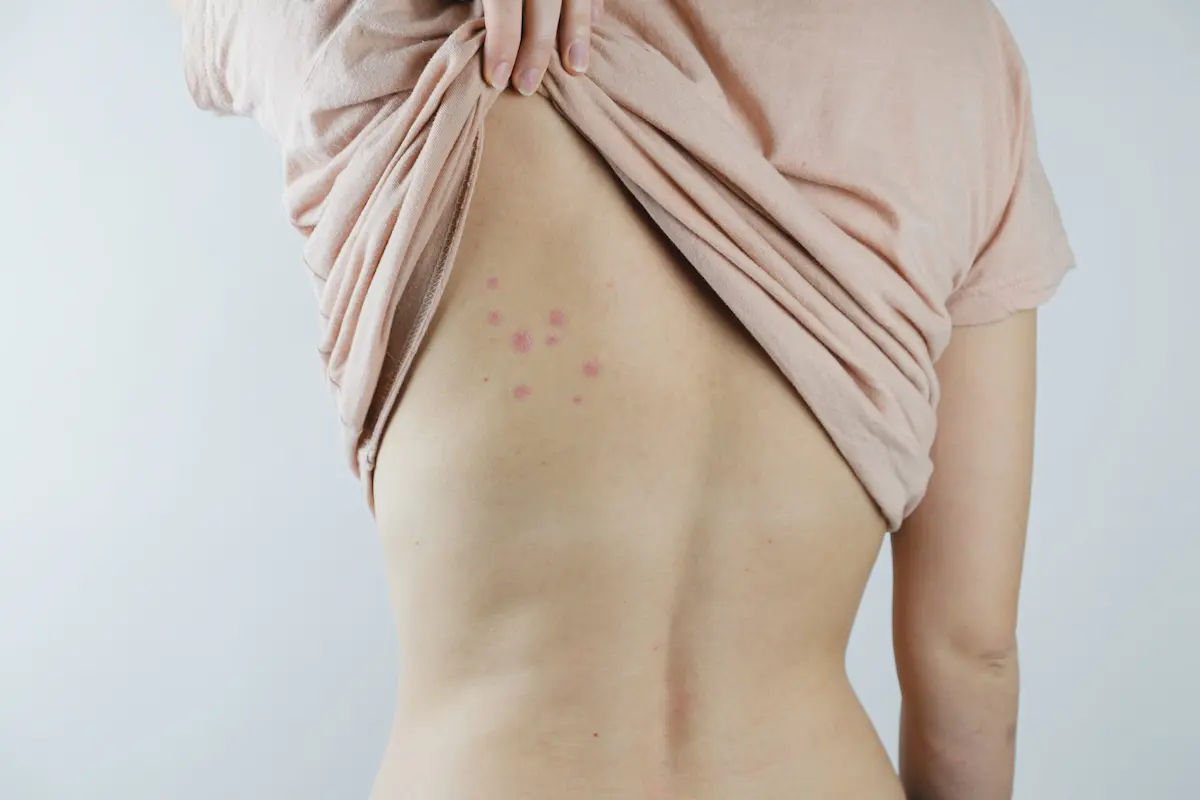 Cluster of bed bug bites and red rash marks on a person’s back.