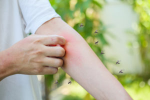 picnic mosquito Man,Itching,And,Scratching,On,Arm,From,Allergy,Skin,Rash